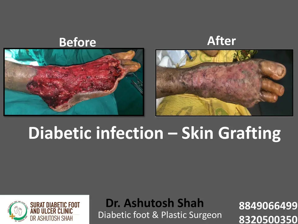 Diabetic Foot  PPT 3 checked by sir.pptx-89.webp